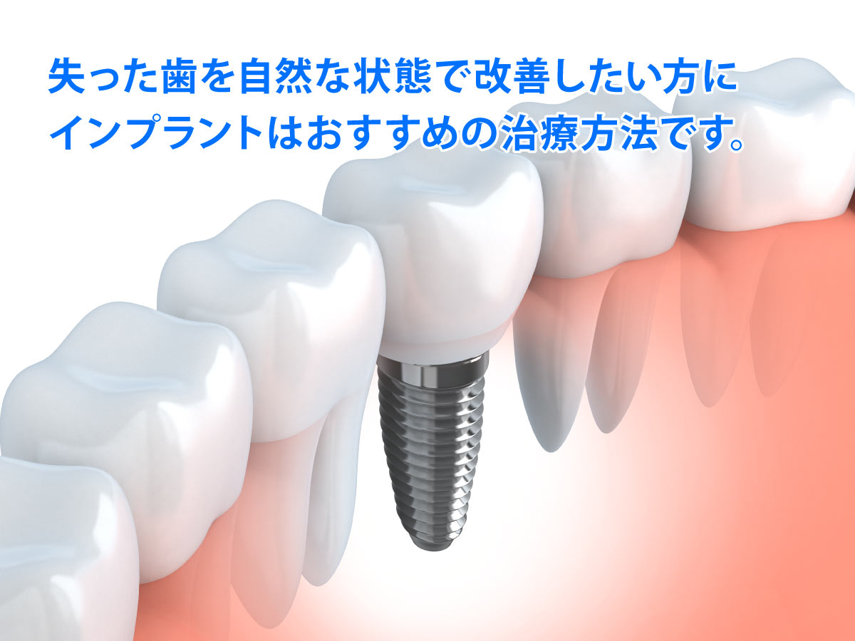 インプラントとは